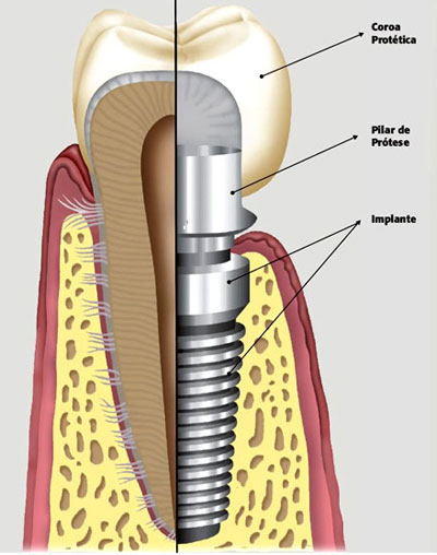 Implantes